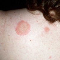 Pityriasis Rosea